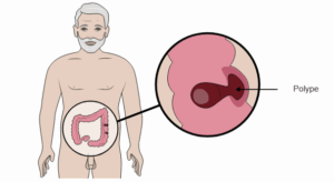 Mon test de dépistage du cancer colorectal est positif. - Centre de ...